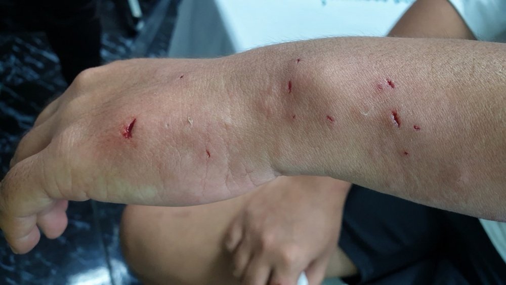 What Happens If Dog Nail Scratches You